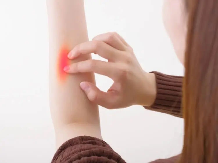 ダニに刺されてかゆい！ダニに効果的な予防法＆対策